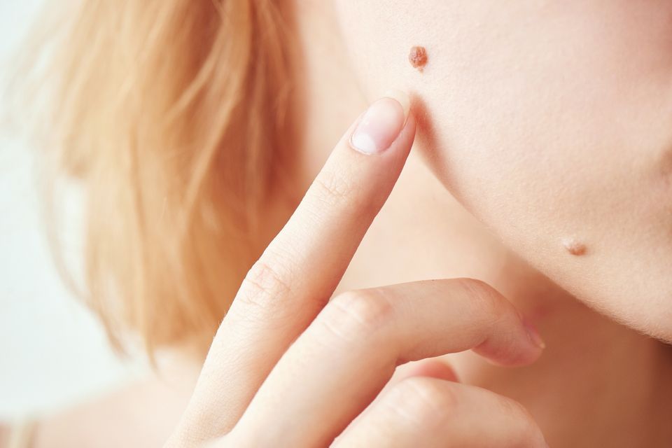 B9 moles
