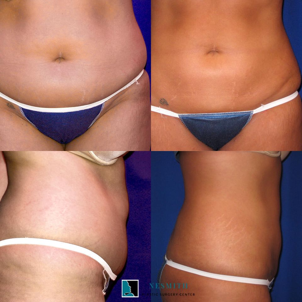 Liposuction lipoplasty 1