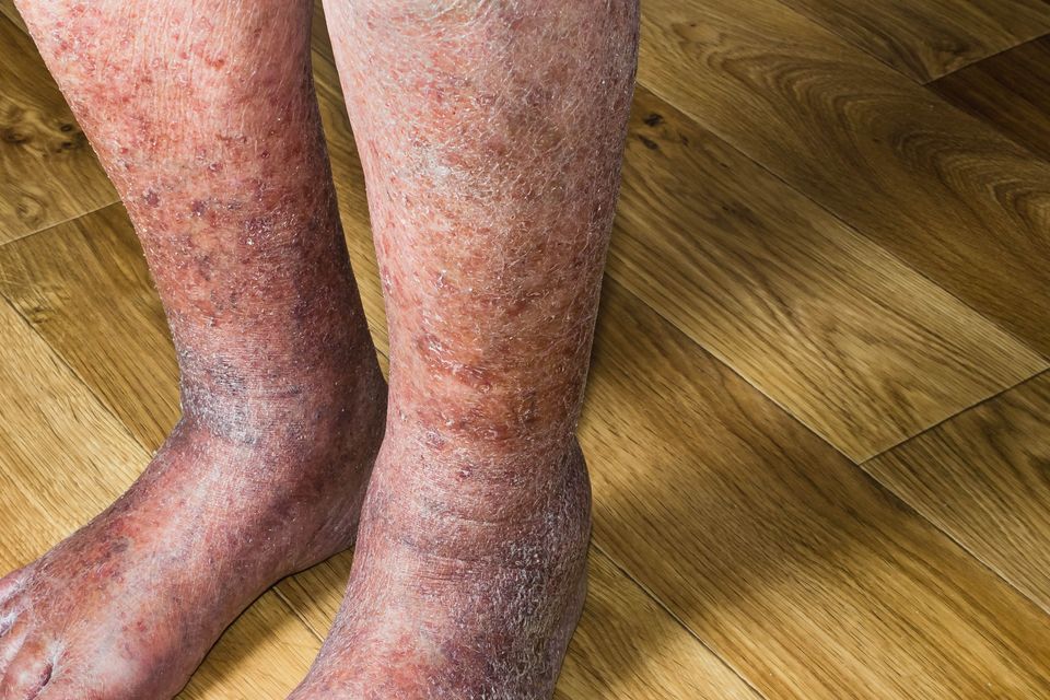 Treatment for eczema and other chronic skin conditions in Logan, Utah