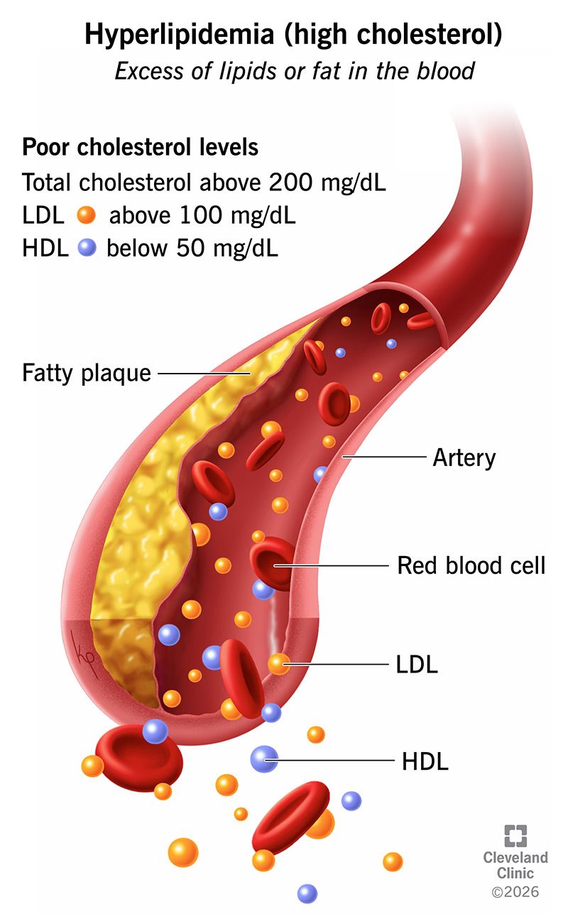 21656 hyperlipidemia