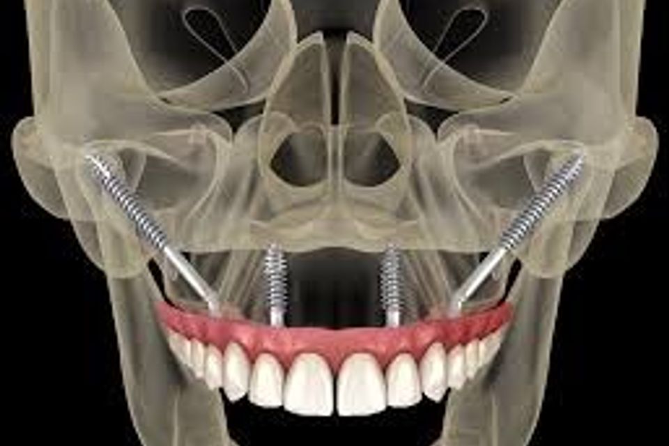 Zygomatic implants