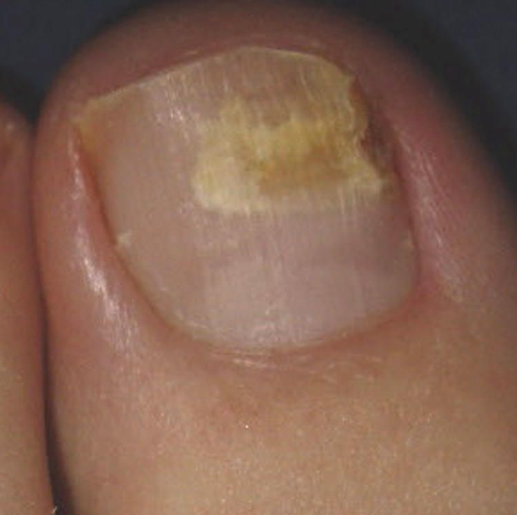 Toenail fungus