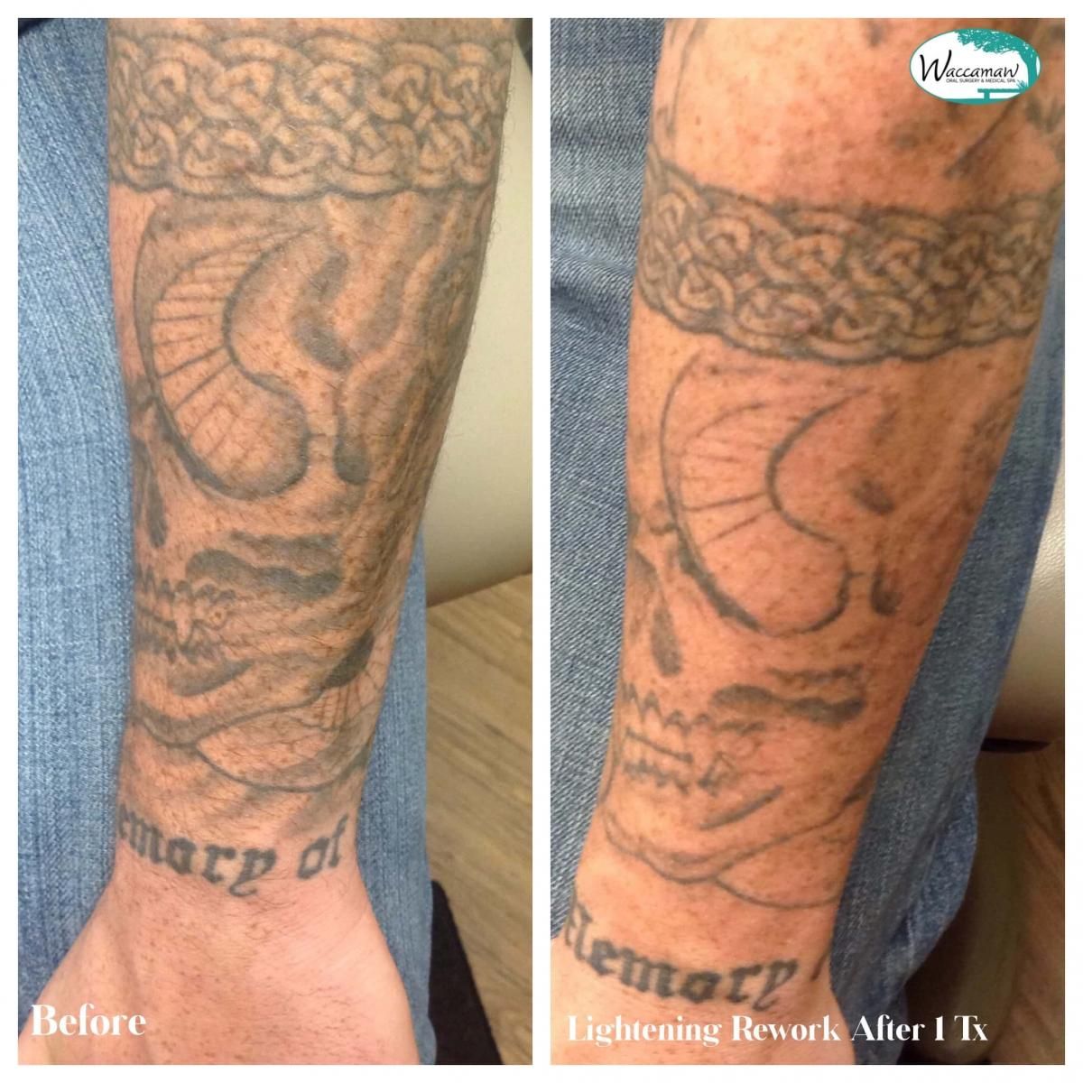THE BEST 10 Tattoo Removal near Myrtle Beach SC 29577  Last Updated June  2023  Yelp