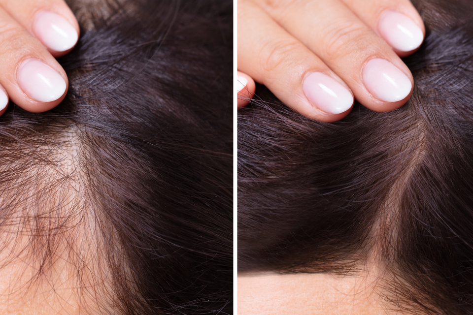 Before-and-after comparison showing improved hair density and scalp coverage following a professional hair replacement treatment.