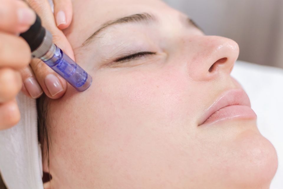 Microneedling