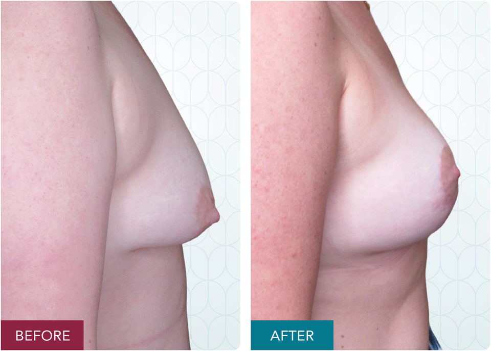 Case 1 augmentation mastopexy