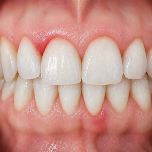 Why are my gums bleeding