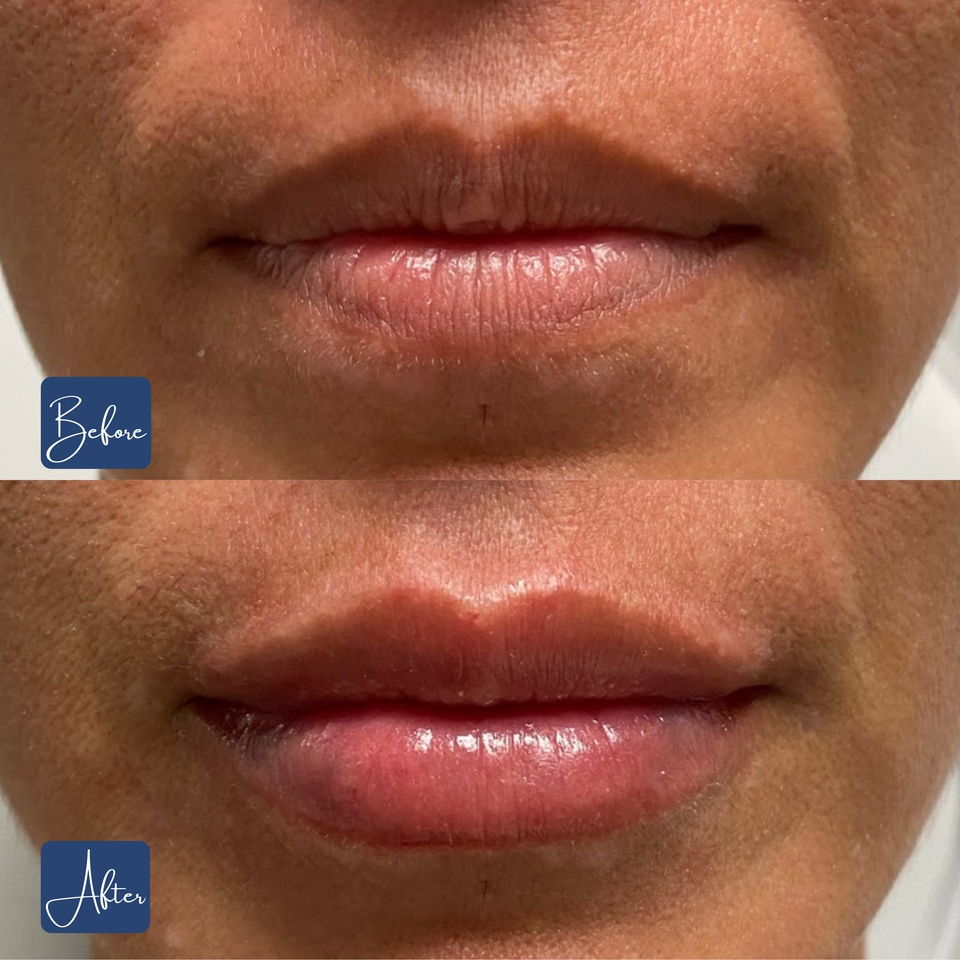 Lips 14
