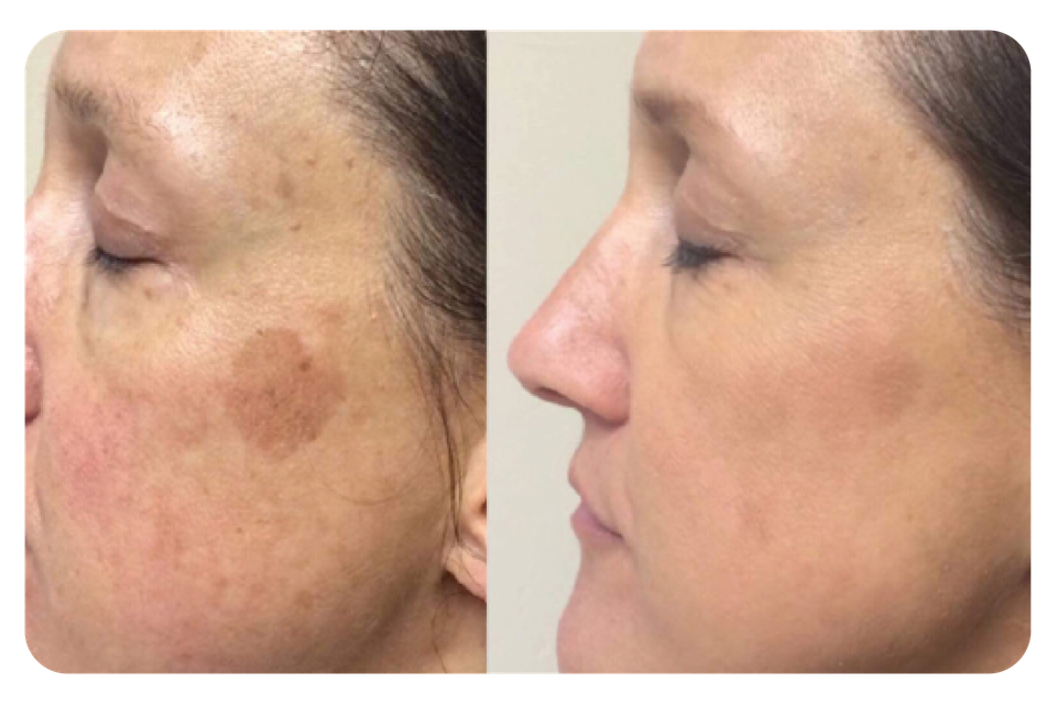 Laser Skin Resurfacing