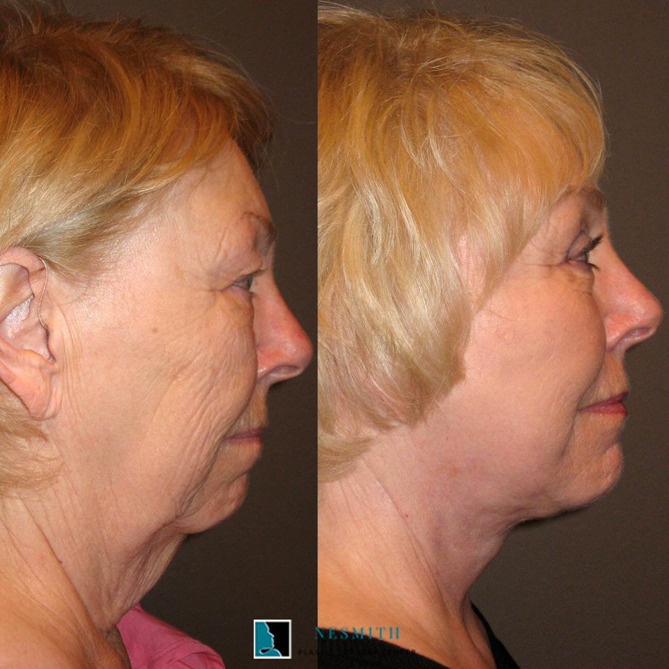 Eyelid surgery blepharoplasty 1