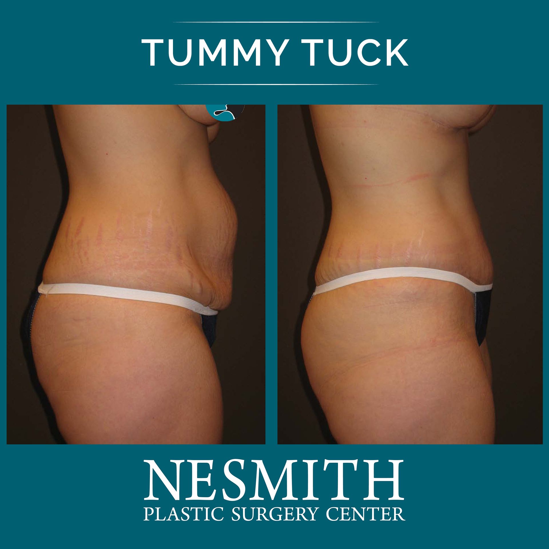 Mini Tummy Tuck Surgery, Gainesville, FL