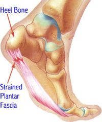 Heel pain