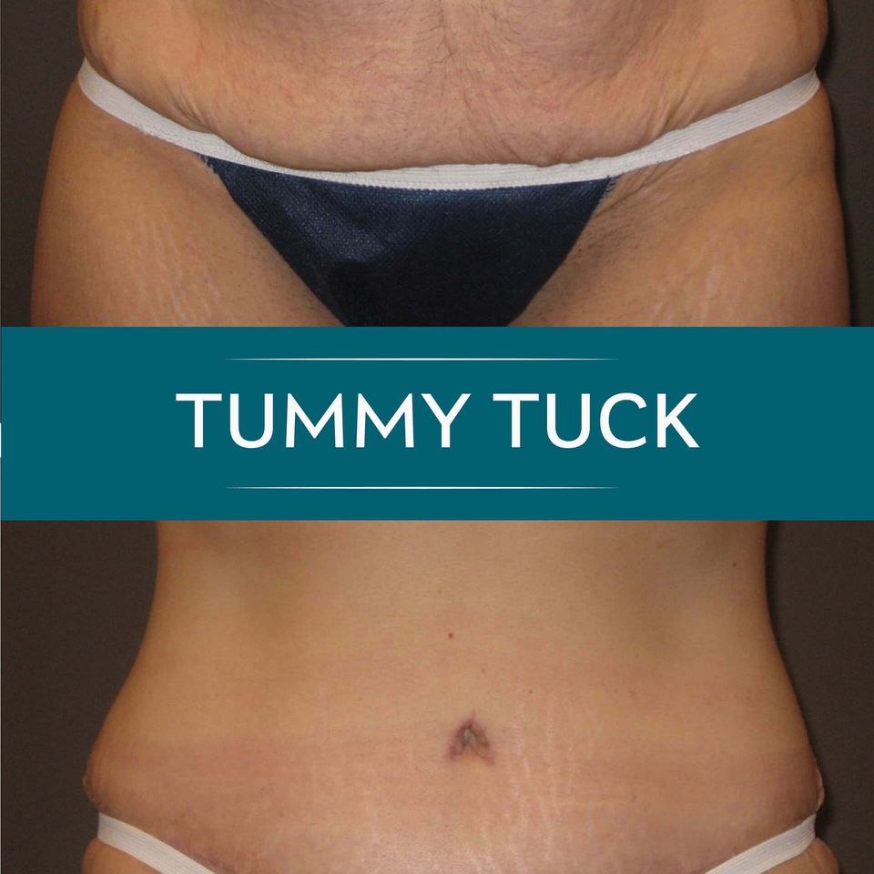 Nps social tummy 02