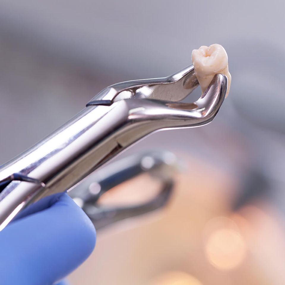 Humbertroaddentistry dentalextraction