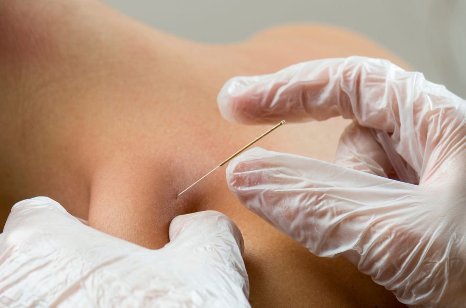 dry needling service designed to alleviate pain and enhance mobility for patients