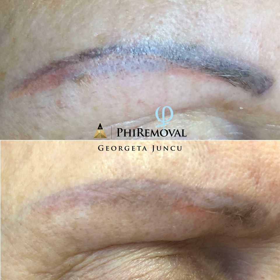 Phiremoval (1)