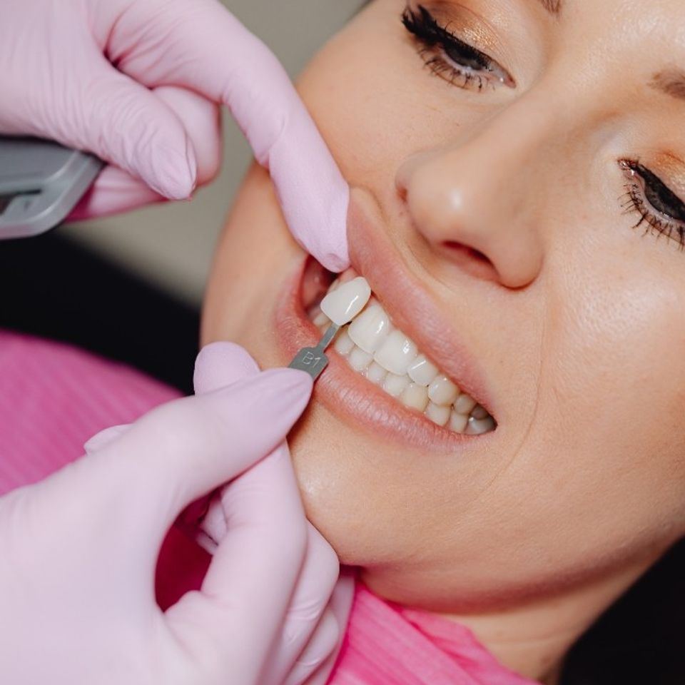 Veneer c